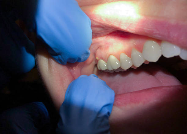Best Urgent Care for Lost Fillings or Crowns in Elmwood, IL