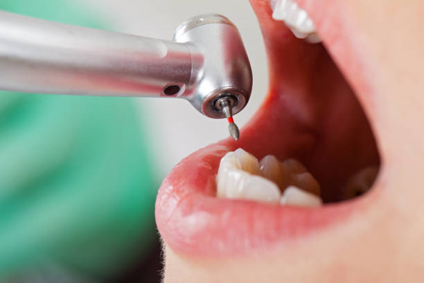 Best Emergency Root Canal Treatment in Elmwood, IL